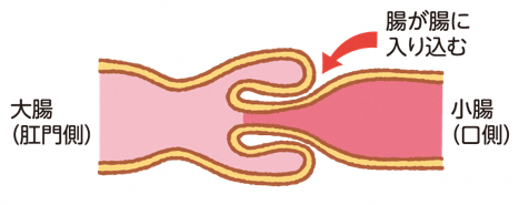 腸重積症のイメージ